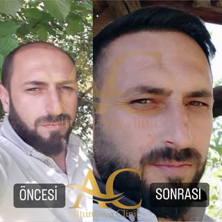 Geç kalmayın, genç kalın👩‍🦲➡️🧔🏻‍♂️ iletişim için;☎️+90 543 973 69 56 veya +90 543 581 02 23
.
.
