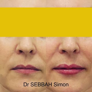 -injection des lèvres pour un effet glossy,
un rendu naturel et un résultat immédiat.
-Injection of 
