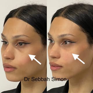 -Regard fatigué ? Des solutions existent avec les injections d’acide hyaluronique, sans douleurs ni