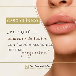 💋 CASO CLÍNICO | ¿Por qué el aumento de labios debe ser progresivo?

Los labios NO❌ deben recibir m