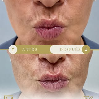 Cuando escucháis la frase de “Dile adiós al código de barras” en medicina estética, nos referimos a 