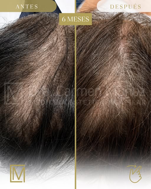 En la alopecia androgénica femenina, la genética hace que el cabello vaya perdiendo densidad de form