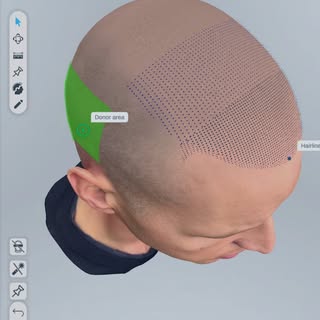 See your results before the procedure even begins. 🤩
Using advanced 3D technology, Dr. Lee designs 