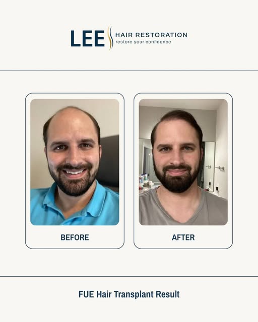 A natural hairline. Balanced density. Confidence that shows.

This is what a well-planned FUE hair t