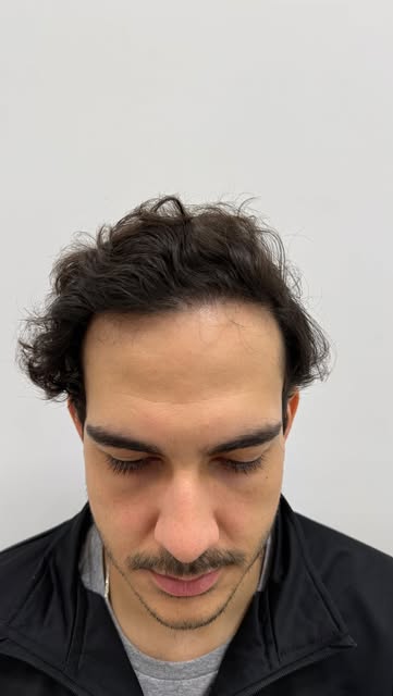 12 meses do pós operatório. Resultado natural.

As imagens apresentadas têm finalidade meramente ilu