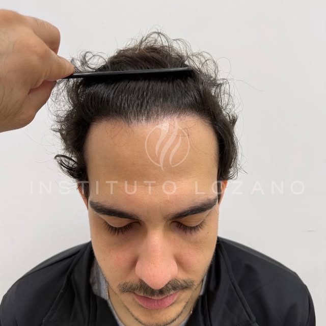 Resultado de 12 meses. Naturalidade e densidade. 

As imagens apresentadas têm finalidade meramente 