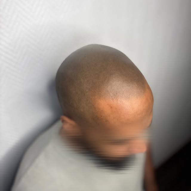 Effet rasé, subtil et imperceptible. 

La tricopigmentation est un véritable travail de précision, o