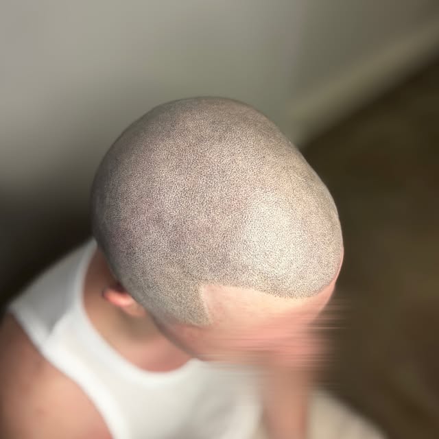 Effet rasé, cheveux forts, avec une densité plus prononcée.

Après une greffe de cheveux, notre clie