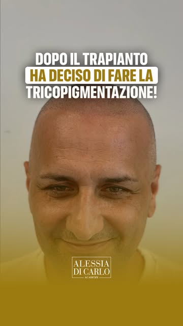 Aveva già fatto un trapianto di capelli, ma qualcosa ancora non lo convinceva: restavano zone traspa