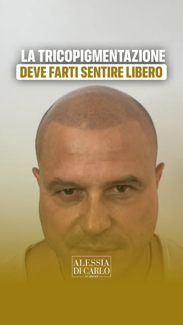 Questa tricopigmentazione l'ho realizzata nel 2019.

Il suo caso partiva da un'alopecia androgenetic