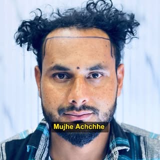 Delhi Mein Sabse Best Clinic hai @goyal_skin_and_hair_clinic ❤️✅
.
.
.
.
.
.
- Best Hair Transplant 