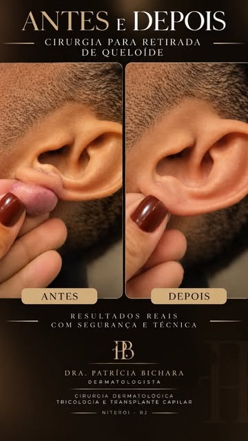 ✨ O queloide na orelha pode causar desconforto, dor, coceira e impactar a autoestima. A boa notícia 