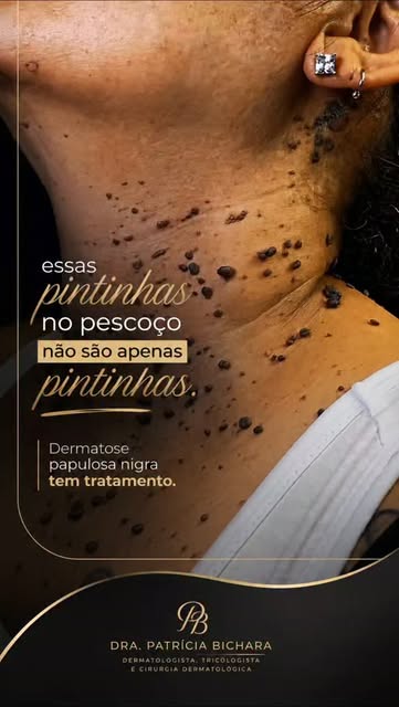 ESSAS “PINTINHAS” NO PESCOÇO NÃO SÃO APENAS PINTINHAS… 👀

Você já percebeu pequenas bolinhas ou pon