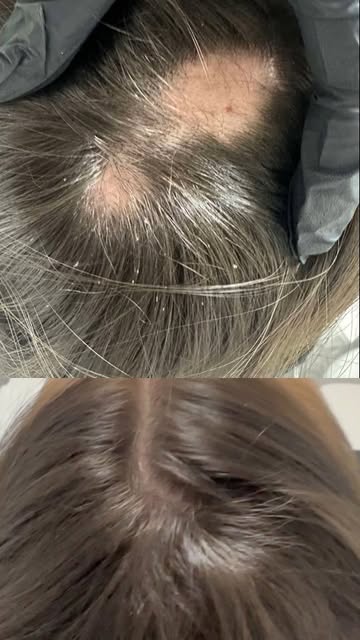 SETEMBRO | MÊS DE CONSCIENTIZAÇÃO DA ALOPECIA AREATA 🎗️

Você sabia que uma pequena falha no cabelo
