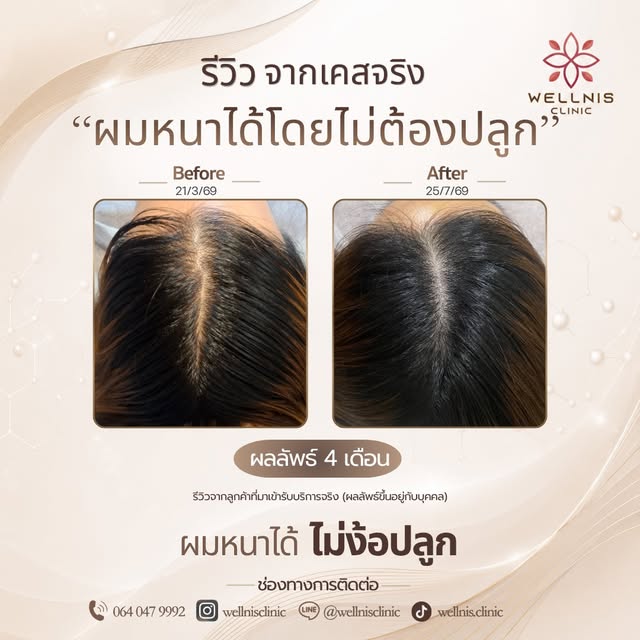 ผมบางมานานกว่า 𝟓ปี มีประวัติครอบครัวผมบาง โดยคุณแม่ก็มีภาวะผมบางเช่นกัน จึงเข้ามาตรวจวิเคราะห์รากผม