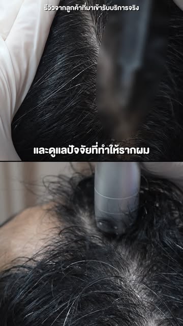 ผมหนาขึ้นใน 𝟑เดือนจริงหรอ ? 

เคสนี้อายุ 𝟐𝟗ปี ผมเริ่มบางบริเวณขวัญและเว้าเอ็ม มาประมาณ 𝟏-𝟐ปี แล