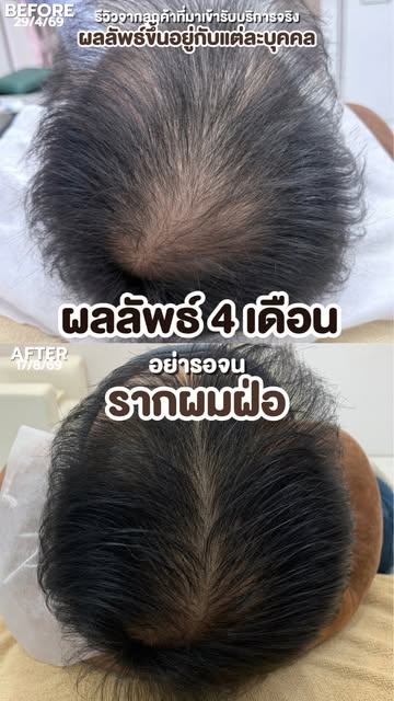 อายุยังไม่ถึง 𝟔𝟎 แต่บางขนาดนี้แล้วเหรอ ? แล้วจะเปลี่ยนผมบางเกือบครึ่งหัว 
ให้ดูหนาขึ้นได้ใน 𝟒เดือ