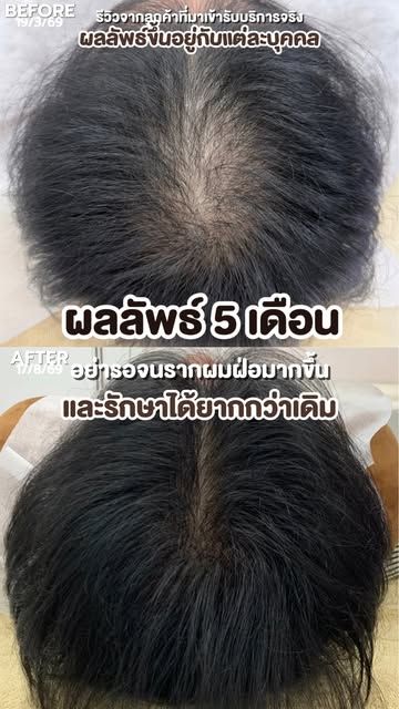 เห็บแว้บแรก อายุแค่ 𝟐𝟓ปี ผมบางขนาดนี้แล้วเหรอ แทบไม่อยากเชื่อ

เคสนี้เริ่มรู้สึกว่าผมบางมาประมาณ �