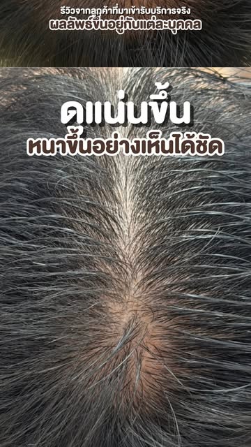 ผมบางจากพันธุกรรมและฮอร์โมน  ต้องปลูกผมจริงไหม ?

เคสนี้อายุ 𝟒𝟎ปี ผมบางเกือบครึ่งศีรษะ แต่ผมกลับมา