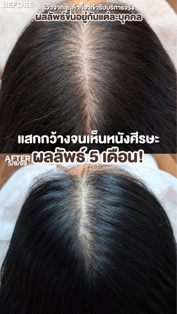 จากแสกที่กว้างจนเห็นหนังศีรษะชัด นี่คือผลลัพธ์หลังผ่านไป 𝟓เดือน

ตอนแรกอาจจะคิดแค่ว่าแสกกว้าง แต่เม