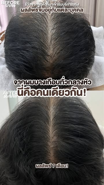 ถ้าเคยผมบางมา 𝟐ปี ยังมีโอกาสกลับมาดูหนาขึ้นไหม ดูเคสนี้!!

อายุ 𝟒𝟖ปี ผมร่วงและบางลงมากอย่างต่อเนื