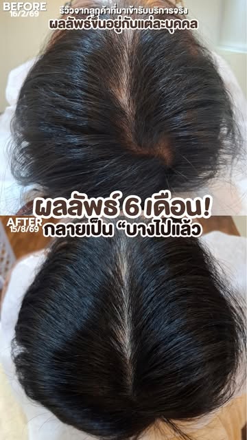 เชื่อไหมว่านี่คือผมของคนที่อายุ 𝟐𝟔ปี 

จากขวัญที่เริ่มบางจนเห็นหนังศีรษะ วันนี้เปลี่ยนไปขนาดนี้ สิ