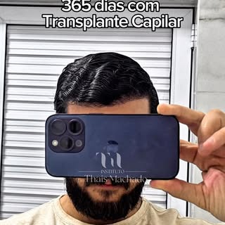 365 dias com transplante capilar 🤎✨

Uma transformação construída etapa por etapa, sempre respeitan