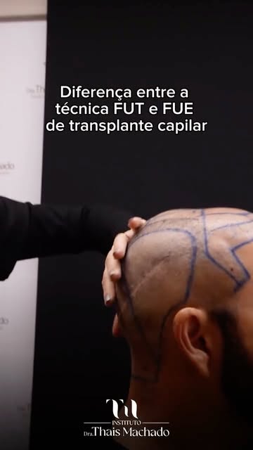 FUT e FUE: você conhece a diferença?

Na técnica FUT, uma faixa de couro cabeludo é retirada da área