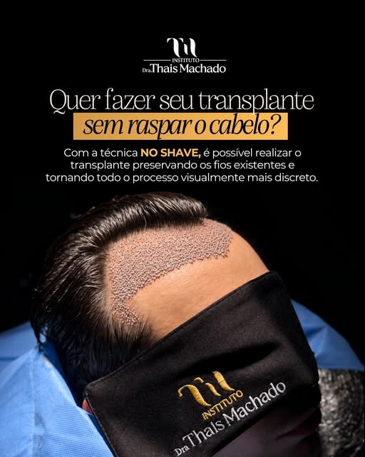 O NO SHAVE é uma possibilidade incrível para quem deseja preservar os fios existentes e passar pelo 