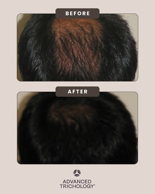 DHT-related hair loss, known as male or female pattern loss, typically appears on the crown of the h