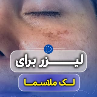 ⁨	ملاسما یکی از مقاوم‌ترین لک‌های پوستی است
و برخلاف تصور عموم، با یک روش یا یک جلسه درمان نمی‌شود.
