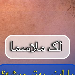 ⁨	❓ ملاسما با لیزر بهتر می‌شود؟

اگر شنیده‌اید که «لیزر برای ملاسما مناسب نیست» یا «لیزر باعث بدتر ش
