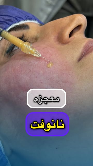 نانوفت؛ فراتر از یک تغییر ظاهری ✨

در این کیس، روند تغییرات پوست را در سه مرحله می‌بینید

هدف از نان