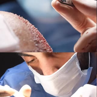 “DHI vs FUE — let’s clear this up.”

DHI is NOT a different procedure.
It’s still FUE… just with a d