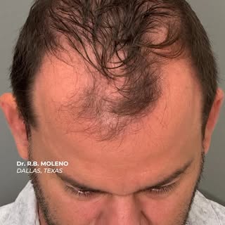 Grafts: 3207
Time since surgery: 6.5 months
Full result at 12 months 

6 months. Real growth.
Strate