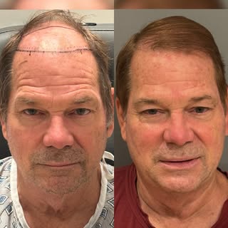 Every patient deserves a personalized plan.

This gentleman underwent a 2,000-graft FUE hair transpl