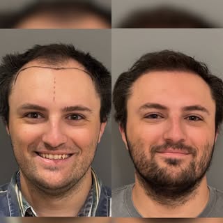 5 Months. 3 Weeks. 3,109 Grafts.

Early growth is looking fantastic, and the best part? He’s not eve