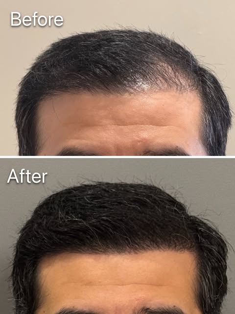 Not every hair transplant delivers the density a patient was hoping for. And sometimes, a second pro