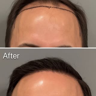 3,122 grafts. One major transformation. 🔥

This patient underwent a 3,122-graft FUE hair transplant