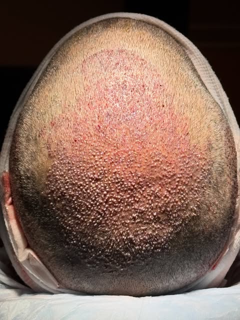2,700 grafts. One crown. Maximum coverage. 👑

Immediate post-op view following a 2,700-graft FUE ha