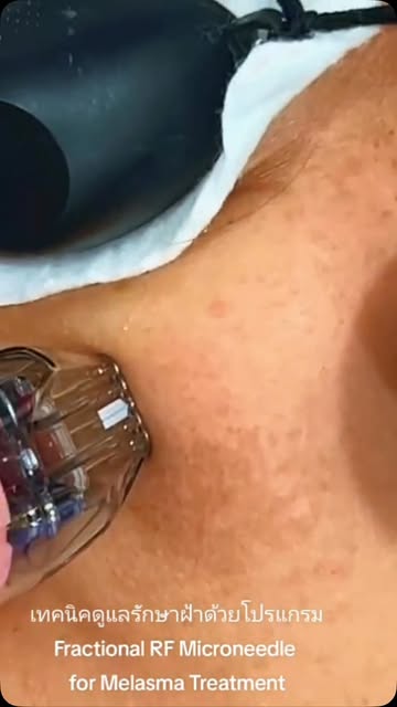 เทคนิคดูแลฝ้าด้วย Fractional RF Microneedling
แนวคิดใหม่ของการรักษาฝ้าไม่ได้มุ่งเพียงลดการสร้างเม็ดส