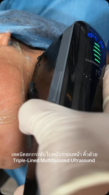 เทคนิคยกกระชับใบหน้า กรอบหน้า และคิ้วด้วย Triple-Line Multifocused Ultrasound

Triple-Line MFU เป็นเ