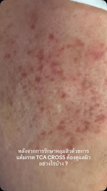 After TCA CROSS for Acne Scars: What Should You Do Next?

TCA CROSS เป็นเทคนิคแต้มกรด TCA แบบเฉพาะจุ