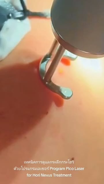 เทคนิคการดูแลกระลึกกระโฮริด้วยโปรแกรมเลเซอร์ Program Pico Laser for Hori Nevus Treatment 
 🔬ลักษณะข