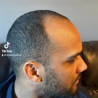 Scalp Micropigmentation #barbers #nottinghambarber #smp #scalpmicropigmentation #scalptattoo #hairta