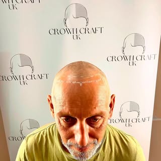 My client has one session left. If you have any hair loss worries contact me love_hair_by_natalie_ba