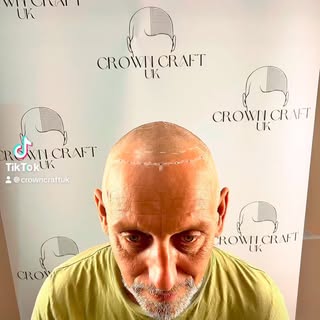 Scalp micropigmentation  #hairlosssolution #HairTransformation  #hairthinningsolution #hairgoals  #b