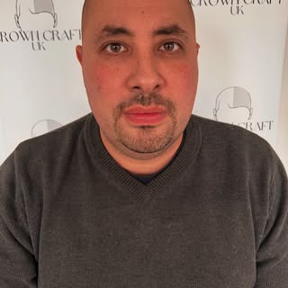 Scalp Micropigmentation the answer to all your hair loss problems.  #scalpmicropigmenation #barberno