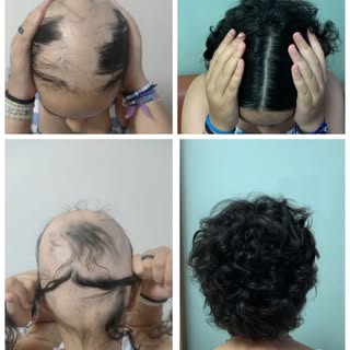 Essa é minha paciente, uma menina de 11 anos que eu acompanho há 2 anos para tratar a alopecia areat