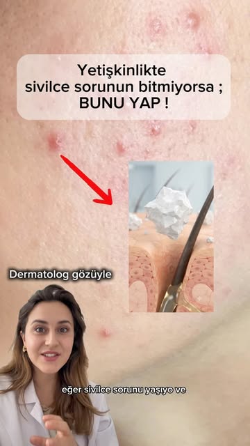 Gözenek tıkayanlar Sıralı liste ! 

1. Talc (Talk)
 Özellikle pudra ve fondötenlerde sık kullanılır.